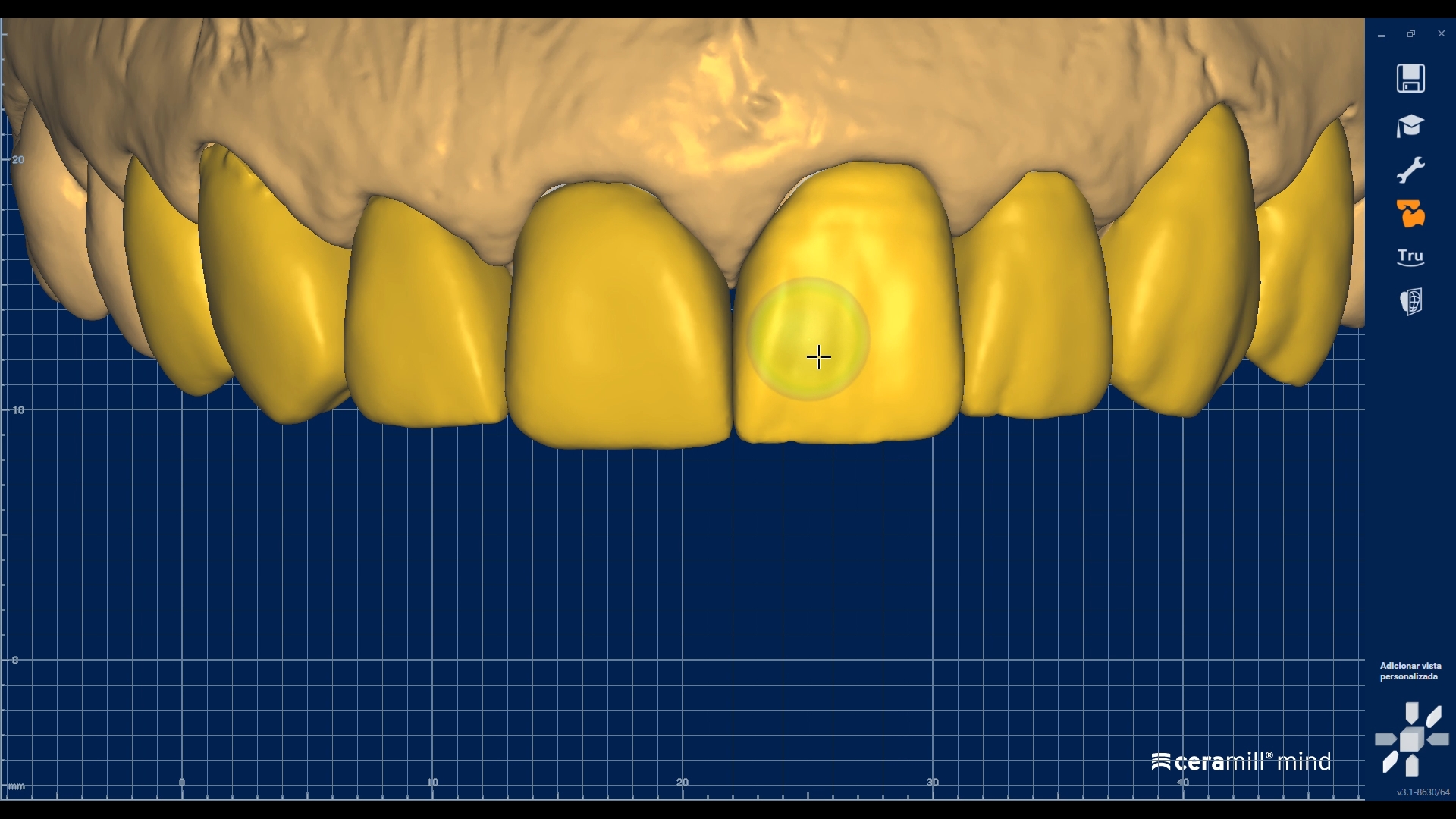 Escultura digital de dentes anteriores no software