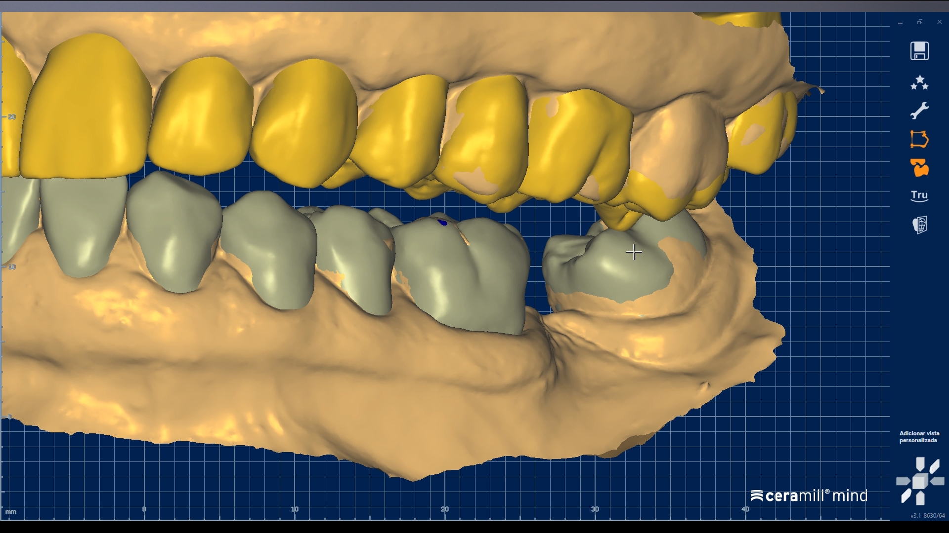 Modelagem anatômica digital no CAD